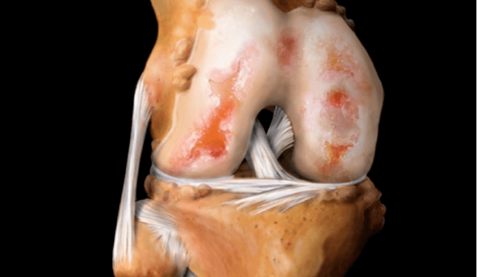 osteoartrite da articulação do joelho