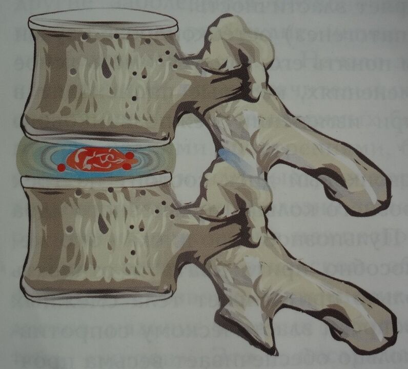 Danos ao núcleo pulposo do disco intervertebral no primeiro estágio da osteocondrose cervical