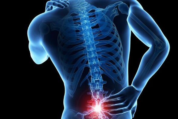 A dor lombar aguda é um sintoma do deslocamento dos discos intervertebrais