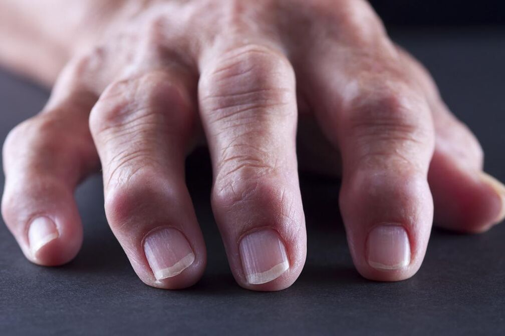 A bursite é caracterizada por dor, inflamação e inchaço das articulações dos dedos