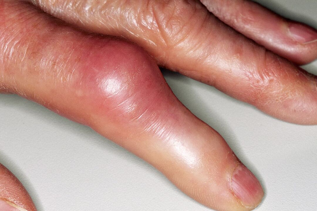 Inchaço, deformação da articulação do dedo e dor aguda após lesão