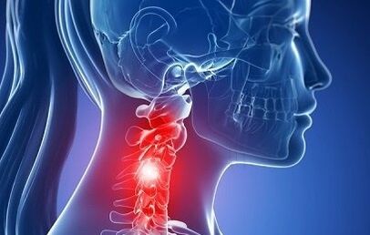 Osteocondrose do pescoço