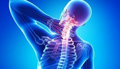 Sintomas e tratamento da osteocondrose cervical