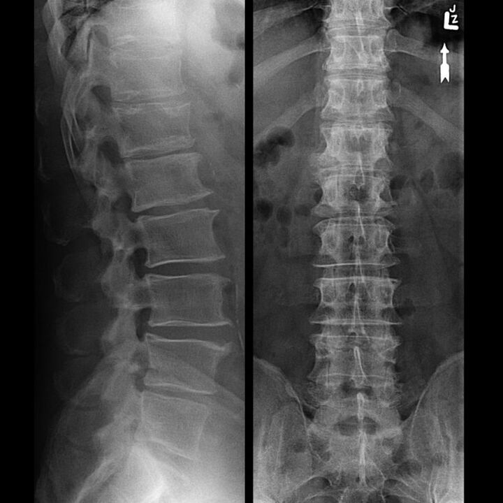 Suspensão da coluna com osteocondrose