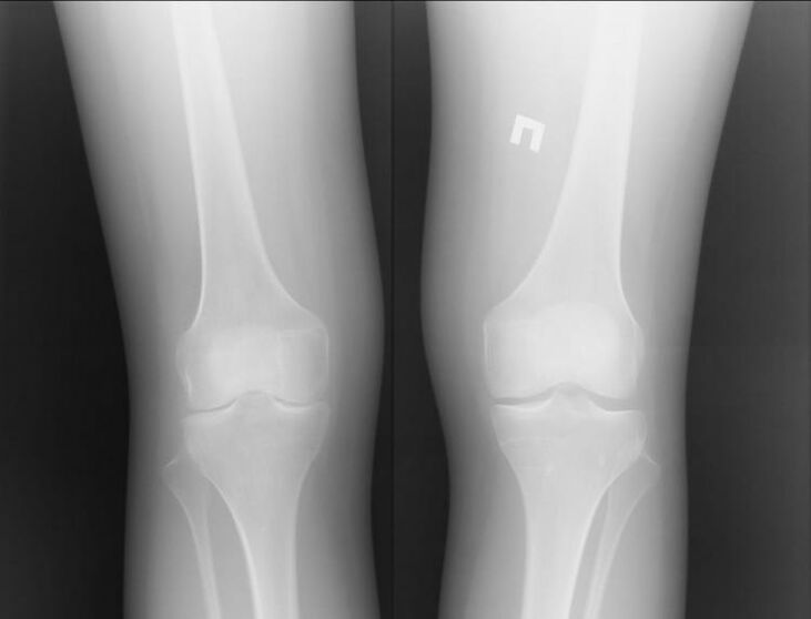 Radiografia de joelhos afetados por artrose