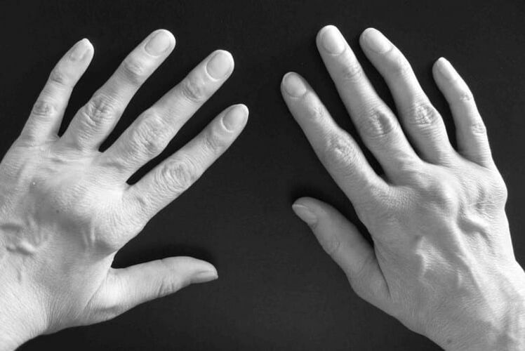 sintomas de artrite nas articulações das mãos