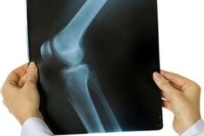 artrose da articulação do joelho na radiografia