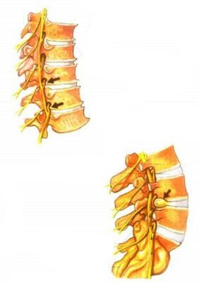 ilustração de osteocondrose espinhal