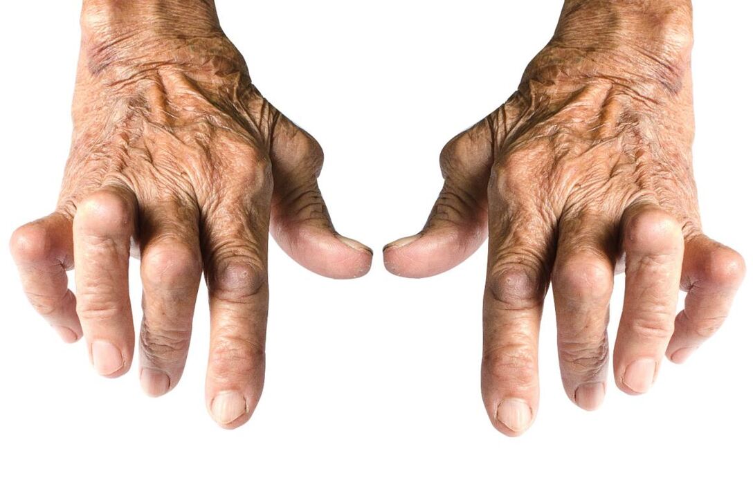 sinais de artrite - deformidade articular